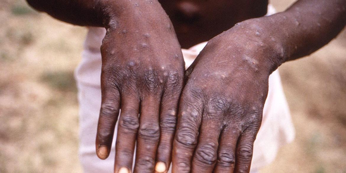 Janaúba foi o primeiro município do Norte de Minas a ter confirmado um caso de Monkeypox (Agência Brasil)